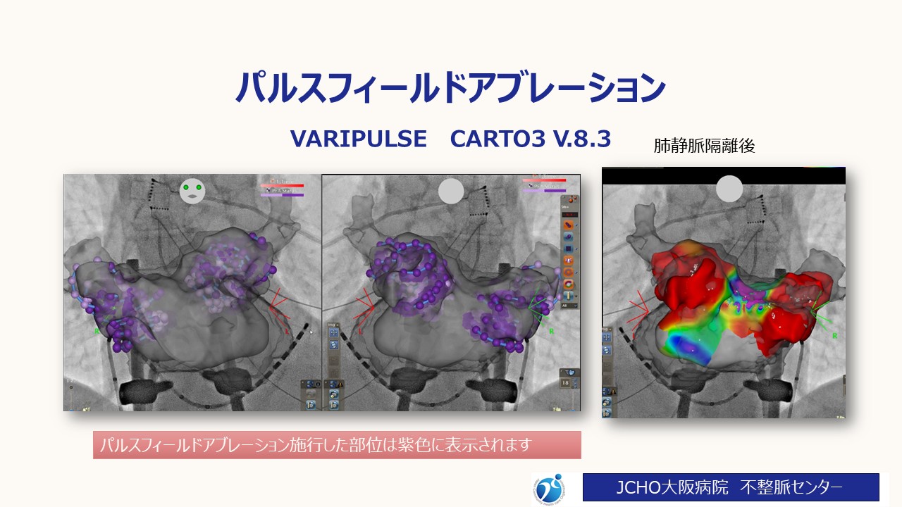 パルスフィールドアブレーション