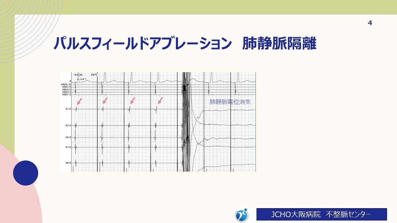パルスフィールドアブレーション 肺静脈隔離