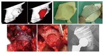 人工股関節再置換術における3Dプリンター技術