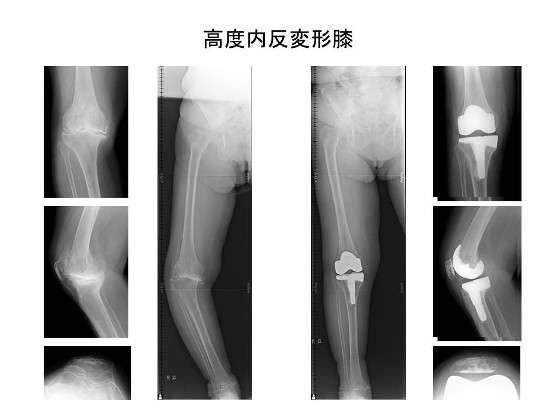 高度内反変形膝