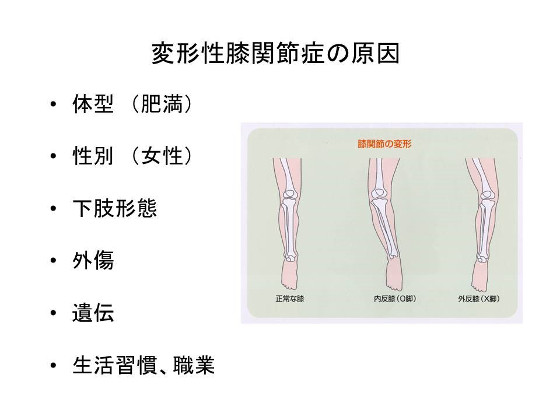 変形性膝関節症の原因