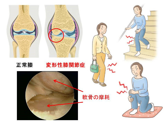 変形性膝関節症の原因