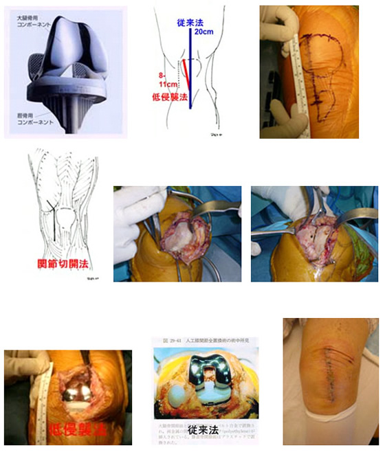 低侵襲人工膝関節置換術(MIS-TKA)