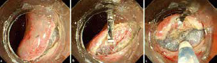 山本がESDを安全確実に行うために独自に開発したクリップフラップ法（Endoscopy UCTN, 2012）