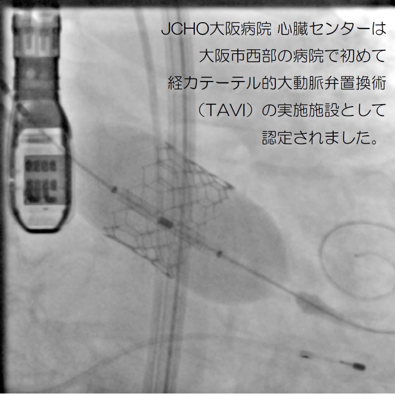 JCHO大阪病院 心臓センターは大阪市西部の病院で初めて経カテーテル的大動脈弁置換術（TAVI）の実施施設として認定されました。
