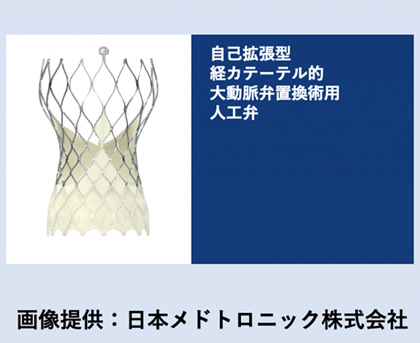 自己拡張型経カテーテル的大動脈弁置換術用人工弁