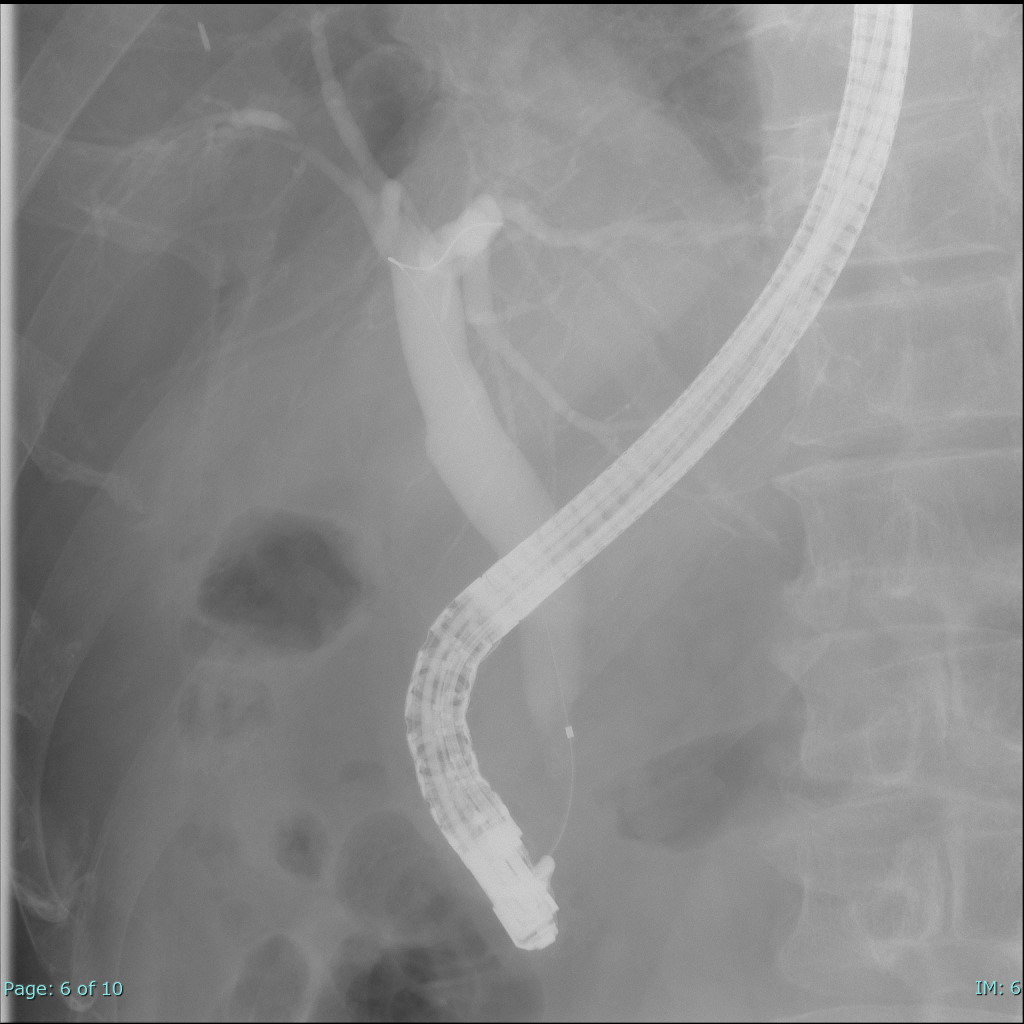 ERCP