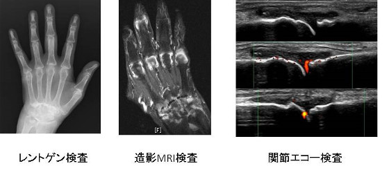 左：レントゲン検査、中央：造影MRI検査、右：関節エコー検査