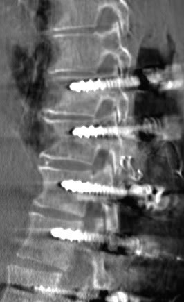 図１　ハイブリッド手術室による術中CT