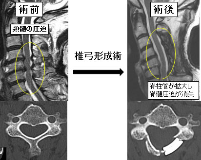 頚椎椎弓形成術