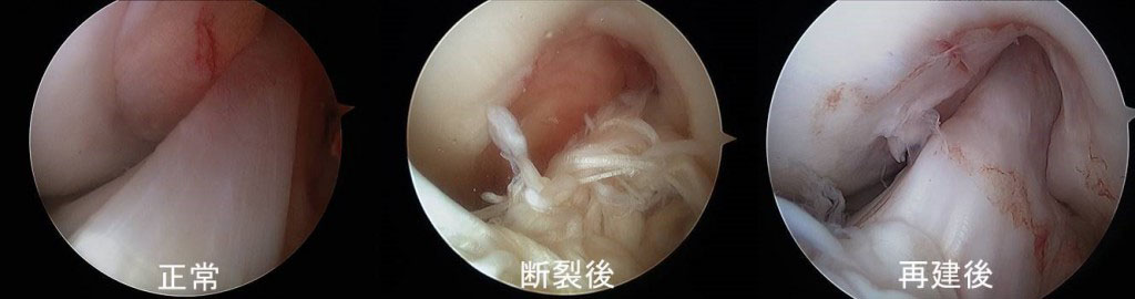 前十字靭帯損傷
