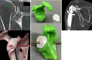 人工関節における術前3D計画と実物大臓器モデル