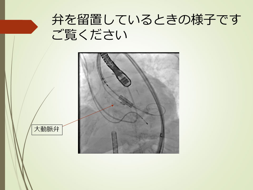 心臓弁膜症