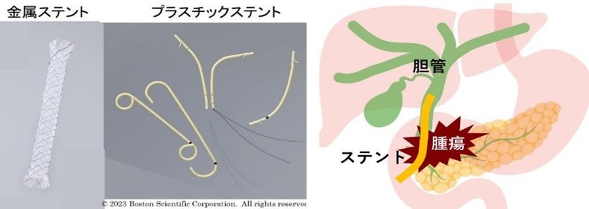 胆道ステント