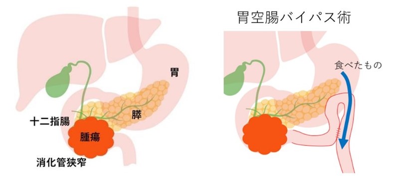 消化管ステント・バイパス療法