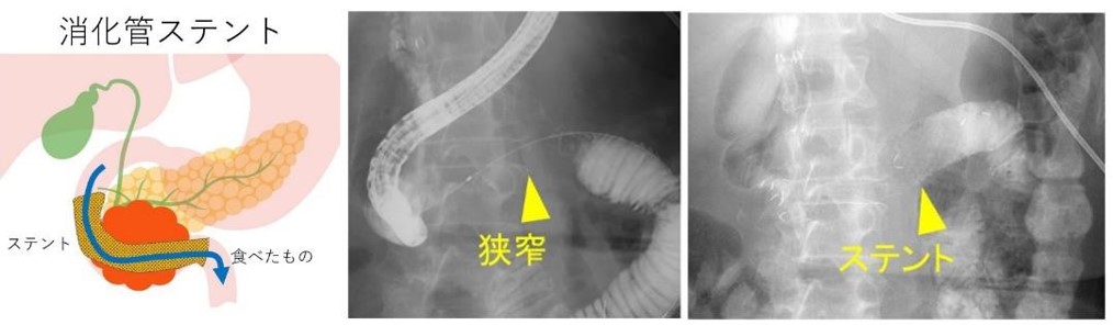 消化管ステント・バイパス療法