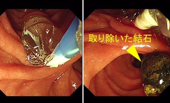 総胆管結石症例