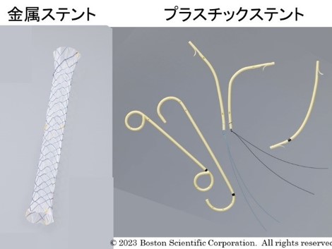 金属ステント/プラスチックステント