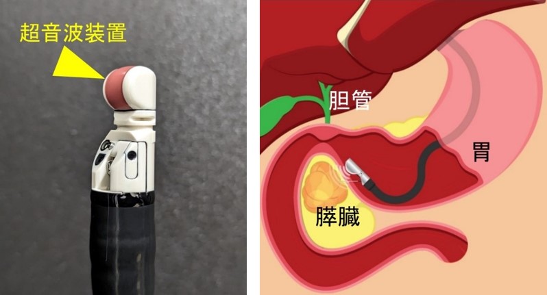 超音波内視鏡検査