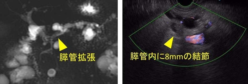 膵癌症例