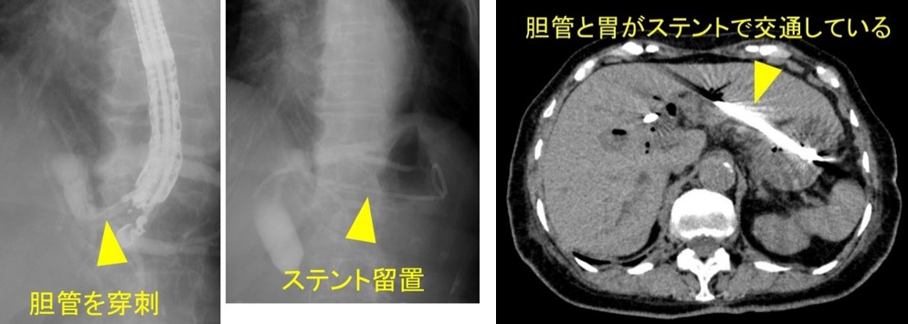 EUSガイド下胆道ドレナージ症例