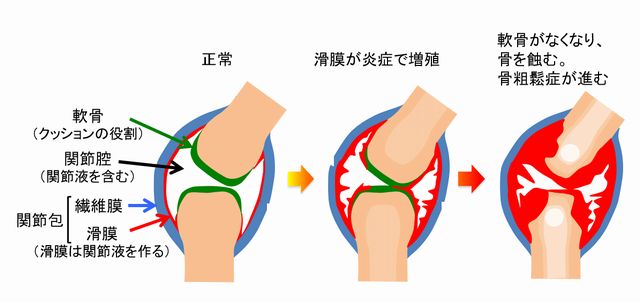 免疫疾患の解説
