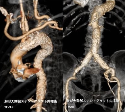 ステントグラフト内挿術後の造影CT画像