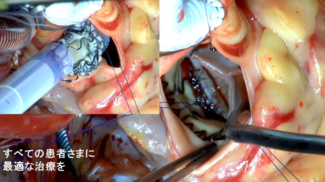 Hybrid手術室での術中写真