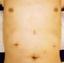 腹腔鏡手術