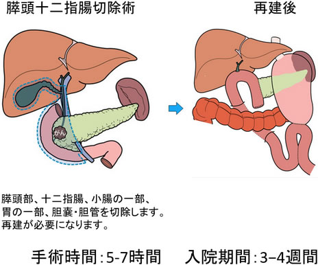 腫瘍が膵頭部にある場合