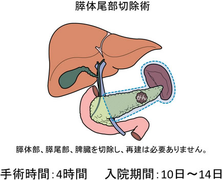 腫瘍が膵体部から膵尾部にある場合