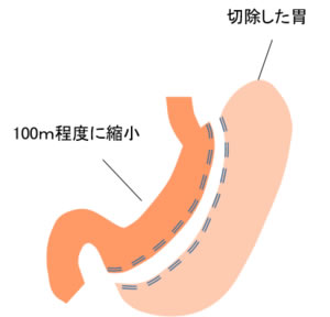 腹腔鏡下スリーブ状胃切除術