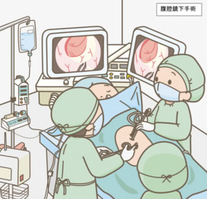 腹腔鏡下スリーブ状胃切除術