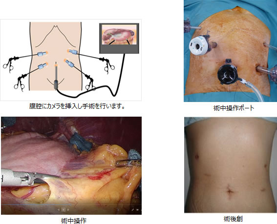 腹腔鏡下胃切除術