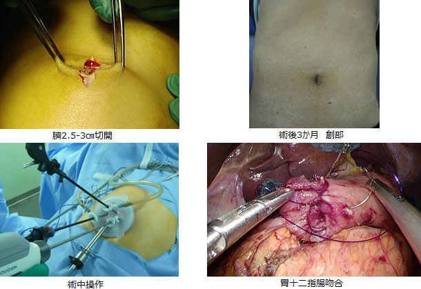 単孔式腹腔鏡下胃切除術