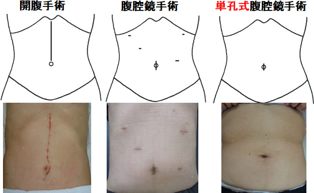 手術創 術式別比較