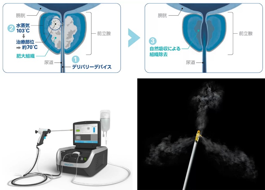 REZUMによる前立腺肥大症に対する経尿道摘水蒸気治療