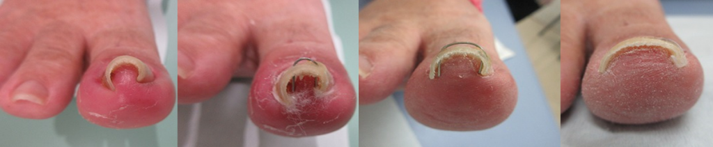 巻き爪　自費診療　3 か月間の治療経過