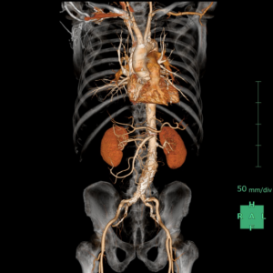3D_Aortic_CT_Check